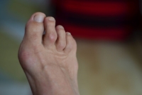 Surgery Options for Hammertoe Deformity
